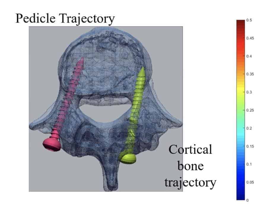 Smart Spine Surgery-from planning to 3D printed templates
