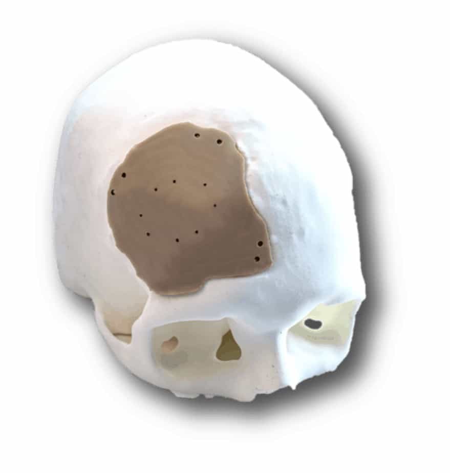 3D printed cranial plate saving up to 85% material in production 