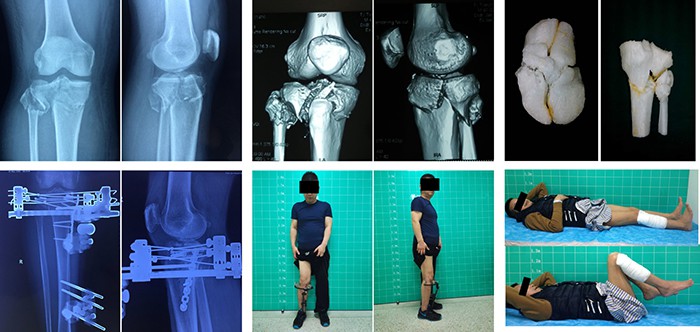 Strategic Issues of 3D Printing in Hospitals -- Example using 3D printing for complex tibial fracture