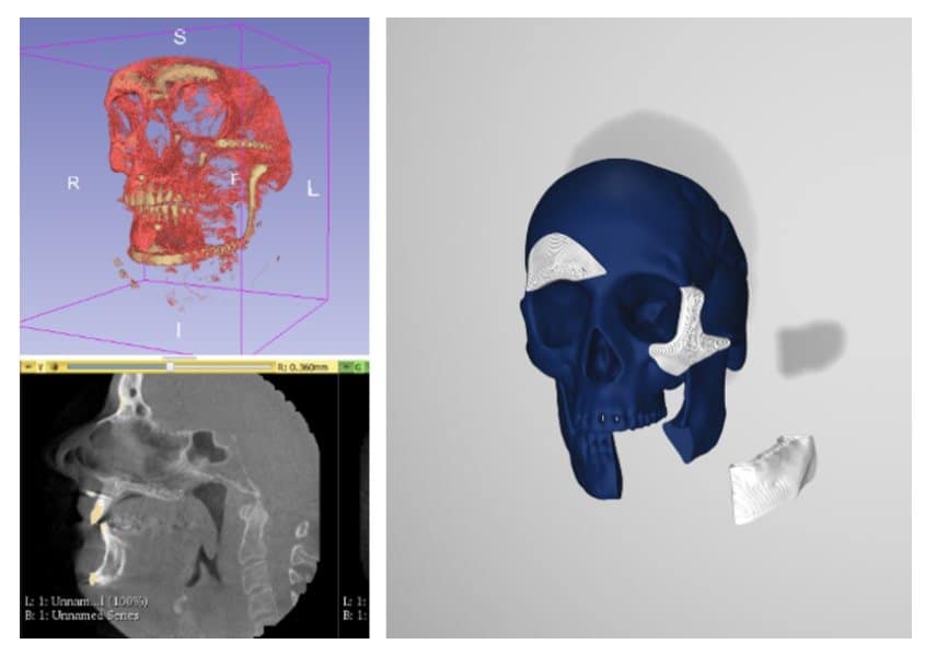 Illustration of Particle3D’s method for 3D modeling patient specific implants  for craniofacial defects based on CT scan data