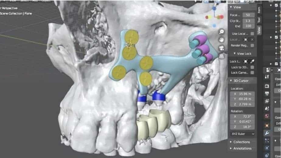 Photo inspiration: Gallery Detail: 3D Printing Implants For Atrophic Jaws