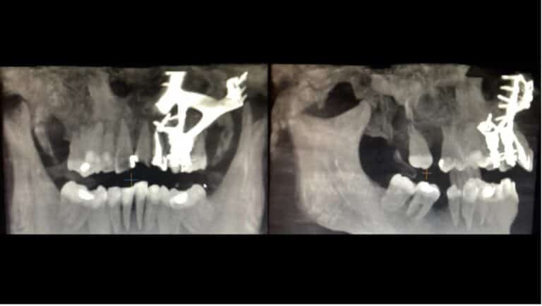 Curated visual reference: Fresh Look at 3D Printing Implants For Atrophic Jaws